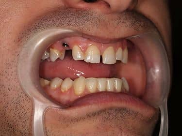 Implant pregătit pentru protezare