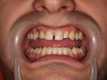 Implant pregătit pentru protezare