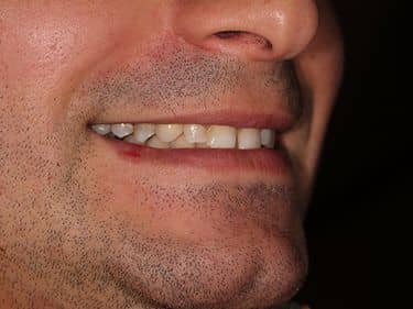 Zâmbet refăcut - Coroană dentară din Zirconiu