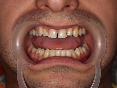 Coroană dentară din Zirconiu pe Implant Dentar