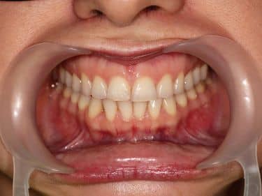 ÎNAINTE - Culoare nesatisfăcătoare a dinților