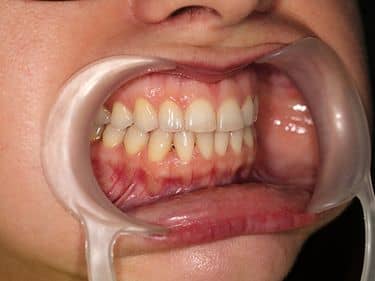 ÎNAINTE - Culoare nesatisfăcătoare a dinților