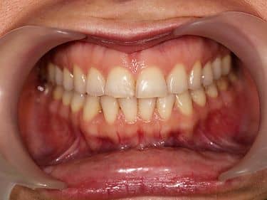 ÎNAINTE - Culoare nesatisfăcătoare a dinților