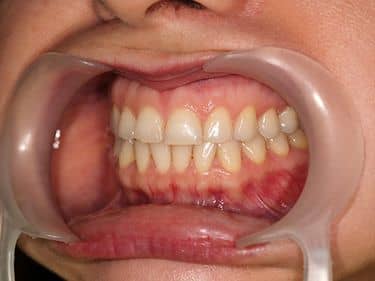 ÎNAINTE - Culoare nesatisfăcătoare a dinților