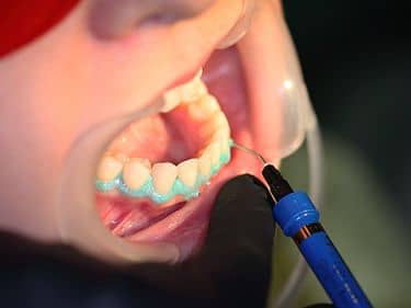 ÎN TIMPUL TRATAMENTULUI - Aplicarea și fotopolimerizarea protecției gingivale