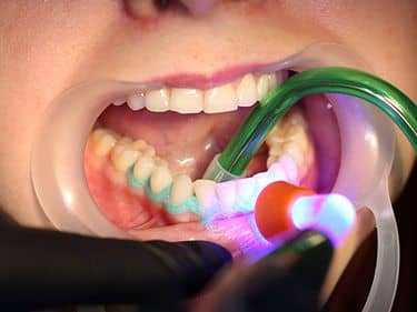 ÎN TIMPUL TRATAMENTULUI - Aplicarea și fotopolimerizarea protecției gingivale