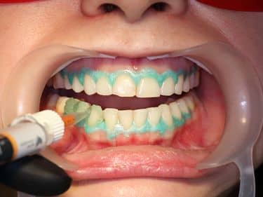 ÎN TIMPUL TRATAMENTULUI - Aplicarea gelului de albire