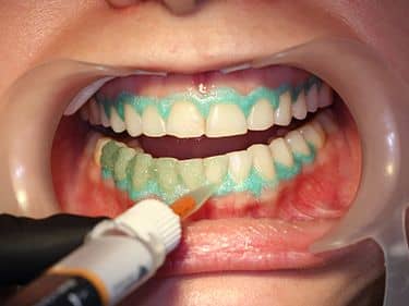 ÎN TIMPUL TRATAMENTULUI - Aplicarea gelului de albire