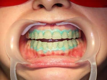 ÎN TIMPUL TRATAMENTULUI - Aplicarea gelului de albire