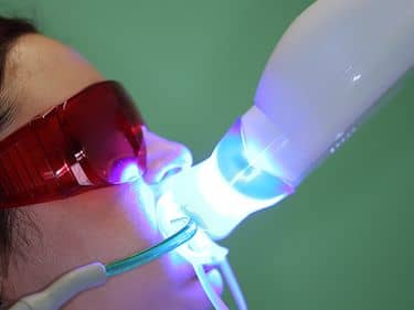 ÎN TIMPUL TRATAMENTULUI - Activarea gelului de albire cu ajutorul lămpii UV tip Zoom / Beyond / Advanced Whitening