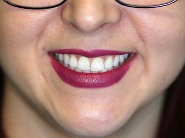 DUPĂ - Zâmbet Strălucitor