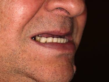 Buză superioară înfundată - Aspect îmbătrânit