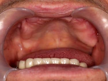 ÎNAINTE - Edentație totală superioară