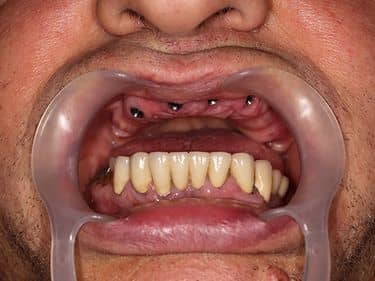 Implanturi dentare pregătite pentru protezare