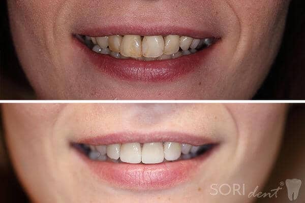 Fațete Dentare și Coroane Integral Ceramice e-max - Înainte și după tratamentul stomatologic