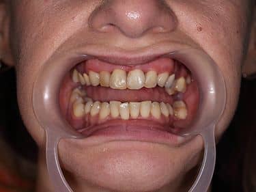 Dinți frontali închiși la culoare