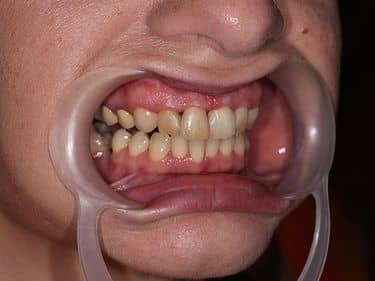 Dinți frontali închiși la culoare