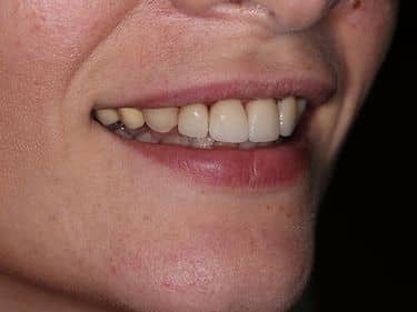 Fațete dentare și coroane integral ceramice e-max