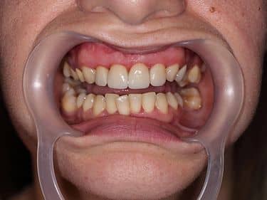 Fațete dentare și coroane integral ceramice e-max