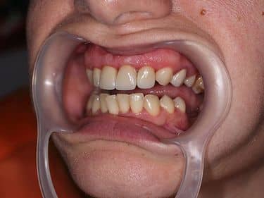 Fațete dentare și coroane integral ceramice e-max