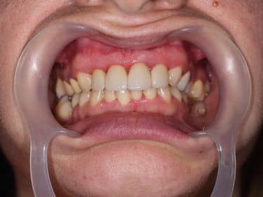 Fațete dentare și coroane integral ceramice e-max