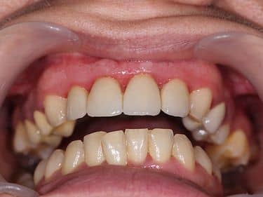 Fațete dentare și coroane integral ceramice e-max