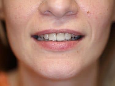 coroane dentare e-Max la Cabinet Stomatologic Bucuresti