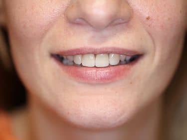 Fațete dentare și coroane integral ceramice e-max