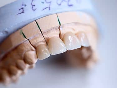 Fațete dentare și coroane integral ceramice e-max