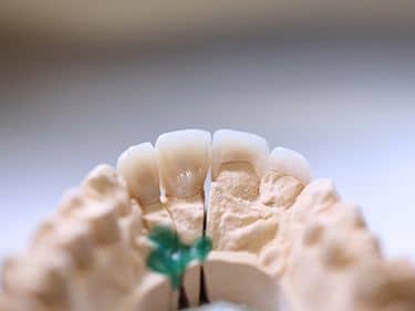 Fațete dentare și coroane integral ceramice e-max