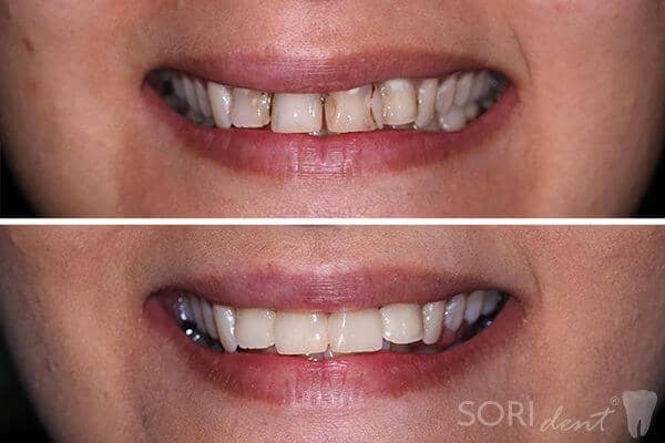 Obturații coronare estetice (plombe) și tratamente de canal (endodontice) - Înainte și după tratamentul stomatologic