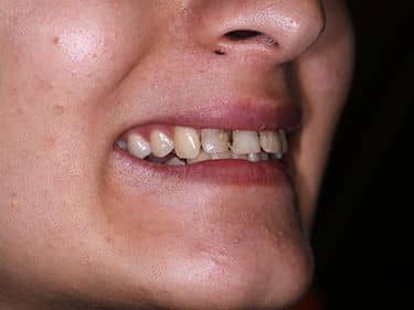 Multiple carii dentare