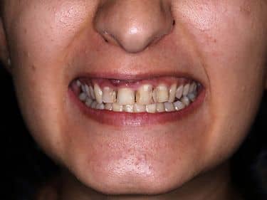 Multiple carii dentare