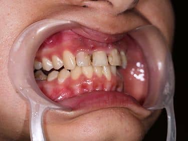 Multiple carii dentare