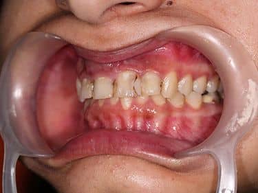 Multiple carii dentare