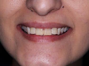 Tratamente dentare și obturații coronare refăcute