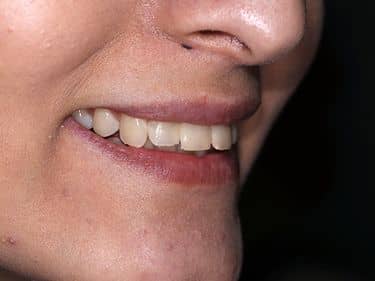 Tratamente dentare și obturații coronare refăcute