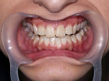 Tratamente dentare și obturații coronare refăcute