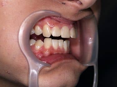 Tratamente dentare și obturații coronare refăcute