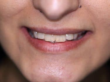 Tratamente dentare și obturații coronare refăcute