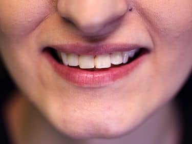 Tratamente dentare și obturații coronare refăcute