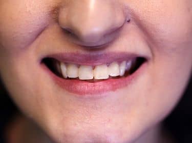 Tratamente dentare și obturații coronare refăcute