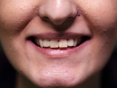 Tratamente dentare și obturații coronare refăcute