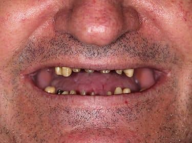 Edentație termino-terminală superioară și latero-laterală inferioară