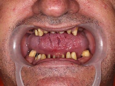 Edentație termino-terminală superioară și latero-laterală inferioară