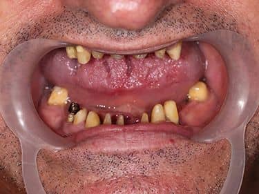 Edentație termino-terminală superioară și latero-laterală inferioară