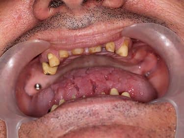 Edentație termino-terminală superioară și latero-laterală inferioară