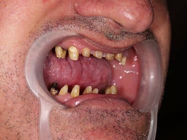 Edentație termino-terminală superioară și latero-laterală inferioară