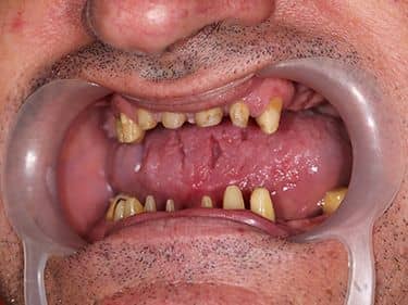 Edentație termino-terminală superioară și latero-laterală inferioară