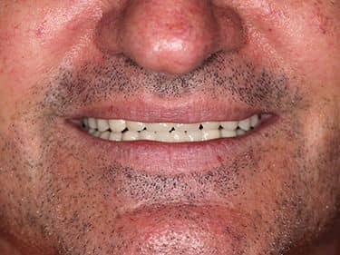 Punți Dentare Metalo-ceramice Fixe cu protezare mixtă